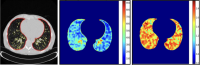 COPD phenotypes of centrilobular emphysema mixed with bronchial thickening with run-length and fractal dimension texture maps